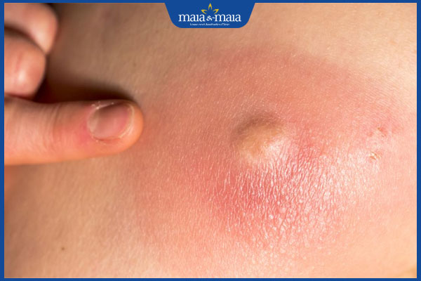 nổi mụn viêm đỏ không nhân