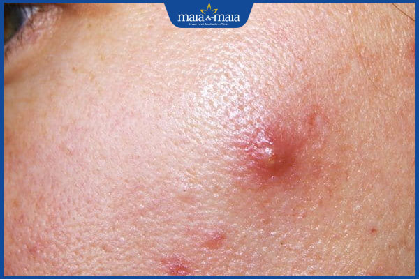 nổi mụn viêm ở má