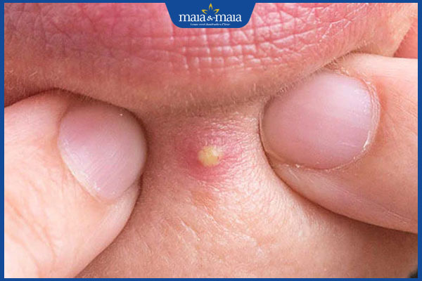Mụn bọc có tự xẹp không? Cách xử lý an toàn không để lại sẹo 2 nốt mụn bọc