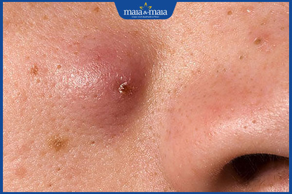 nốt mụn đinh râu