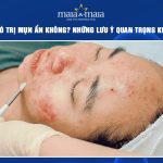 peel da có trị mụn ẩn không