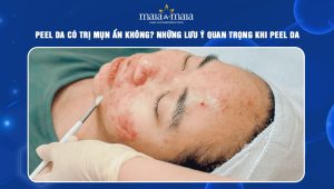 peel da có trị mụn ẩn không
