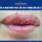 phun môi bị mụn nước