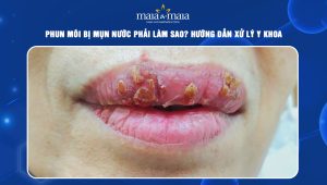 phun môi bị mụn nước