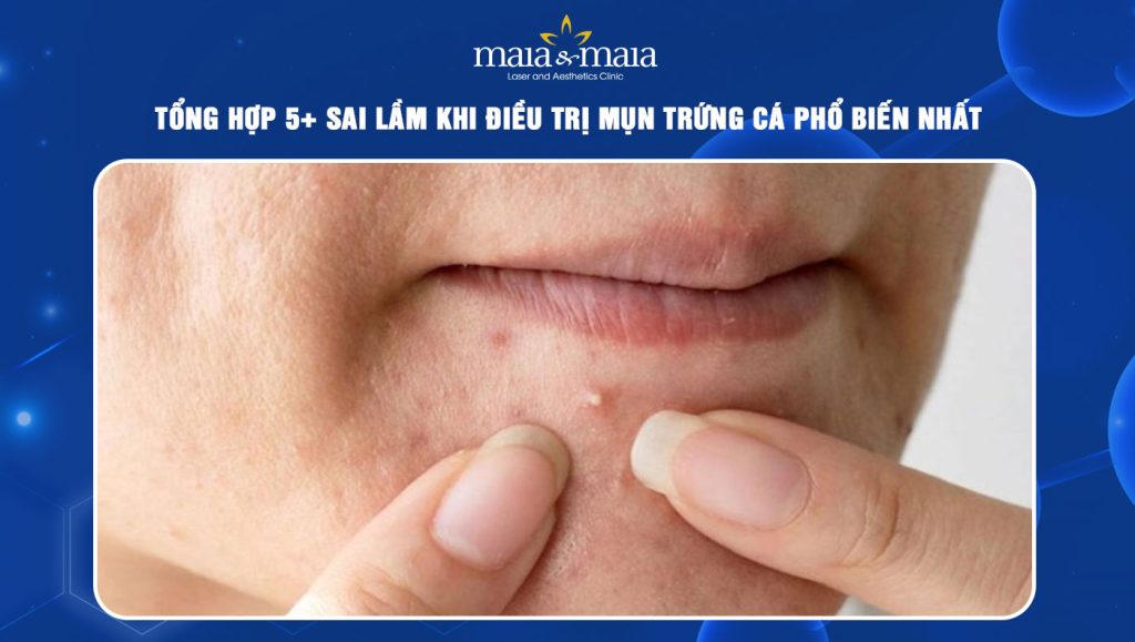 sai lầm khi điều trị mụn trứng cá