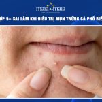 sai lầm khi điều trị mụn trứng cá