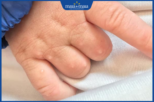 tay trẻ nhỏ nổi mụn nước