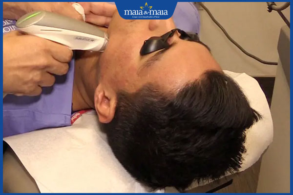 thực hiện trị mụn bằng laser