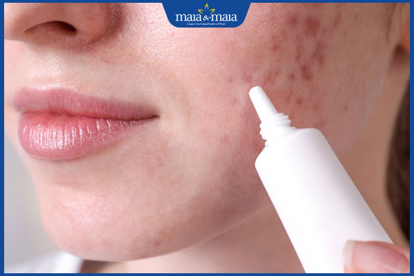 Bác sĩ giải đáp: Mụn viêm đỏ ở má có xử lý triệt để được không? 3 thuốc bôi mụn đỏ