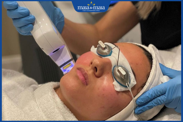 tia laser trị mụn trứng cá