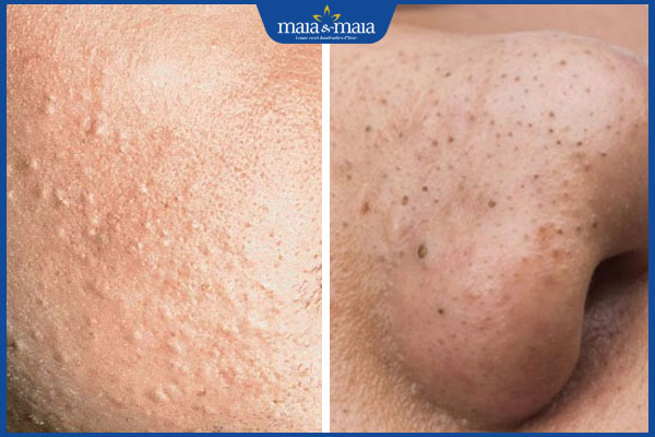 Hướng dẫn xử lý mụn đầu đen và mụn đầu trắng chuẩn y khoa 2 tình trạng mụn đầu đen và mụn đầu trắng