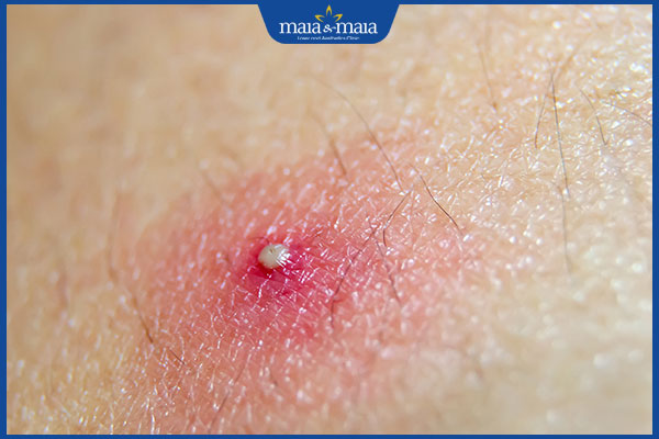 Mụn mủ do đâu? Cách điều trị hiệu quả, hạn chế thâm sẹo trên da 2 tình trạng mụn mủ