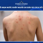 trẻ em bị nổi mụn nước khắp người