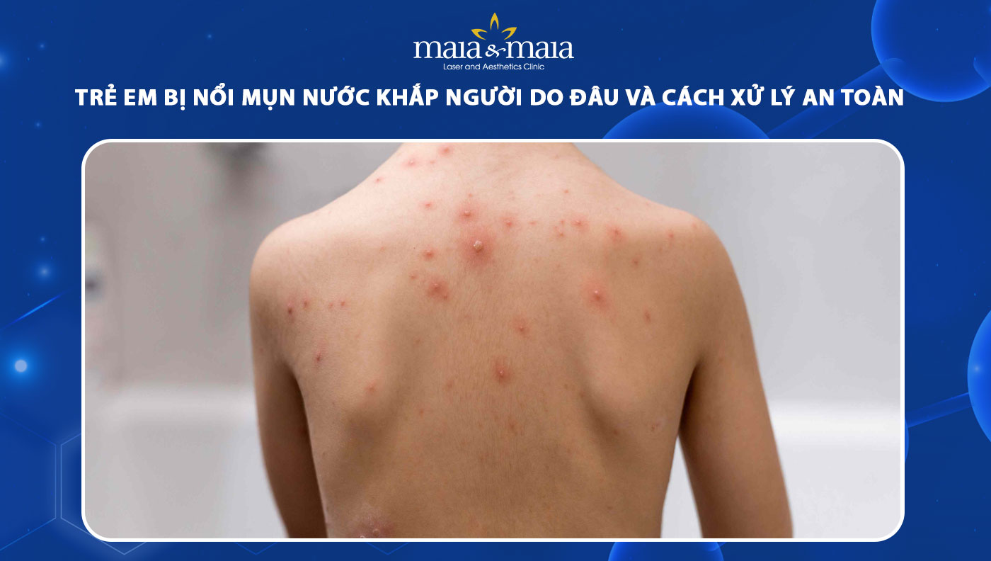 trẻ em bị nổi mụn nước khắp người