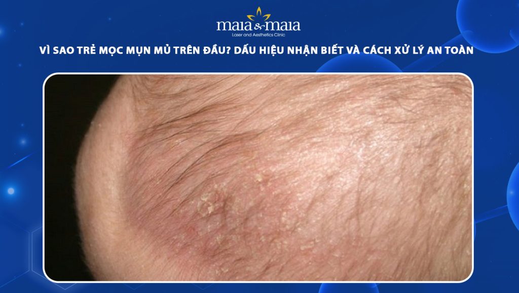 Vì sao trẻ mọc mụn mủ trên đầu? Dấu hiệu nhận biết và cách xử lý an toàn 1 trẻ mọc mụn mủ trên đầu