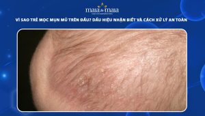 trẻ mọc mụn mủ trên đầu