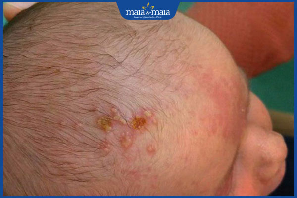 Vì sao trẻ mọc mụn mủ trên đầu? Dấu hiệu nhận biết và cách xử lý an toàn 2 trẻ mọc mụn trên đầu