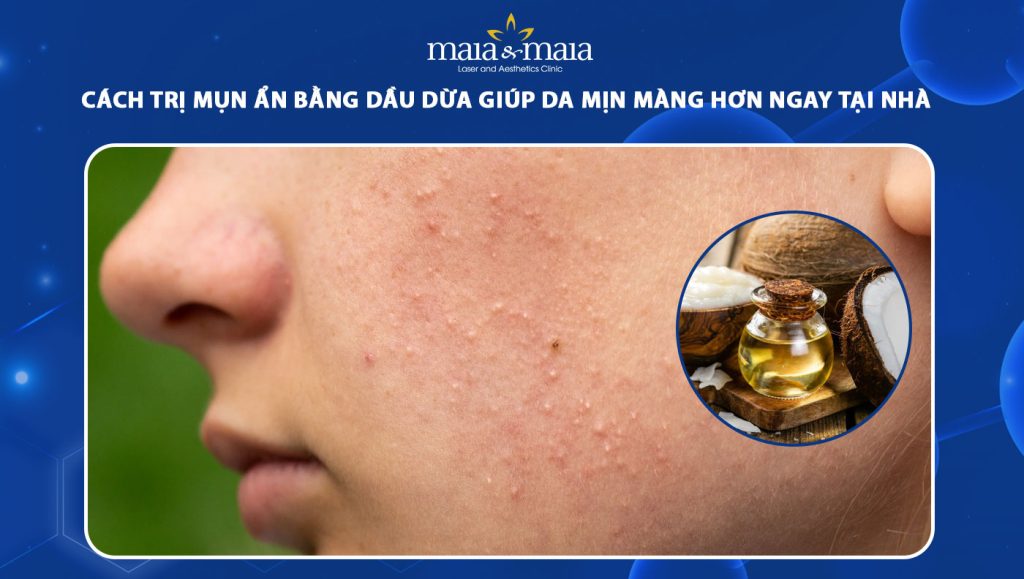 trị mụn ẩn bằng dầu dừa