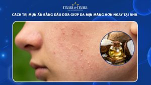 trị mụn ẩn bằng dầu dừa