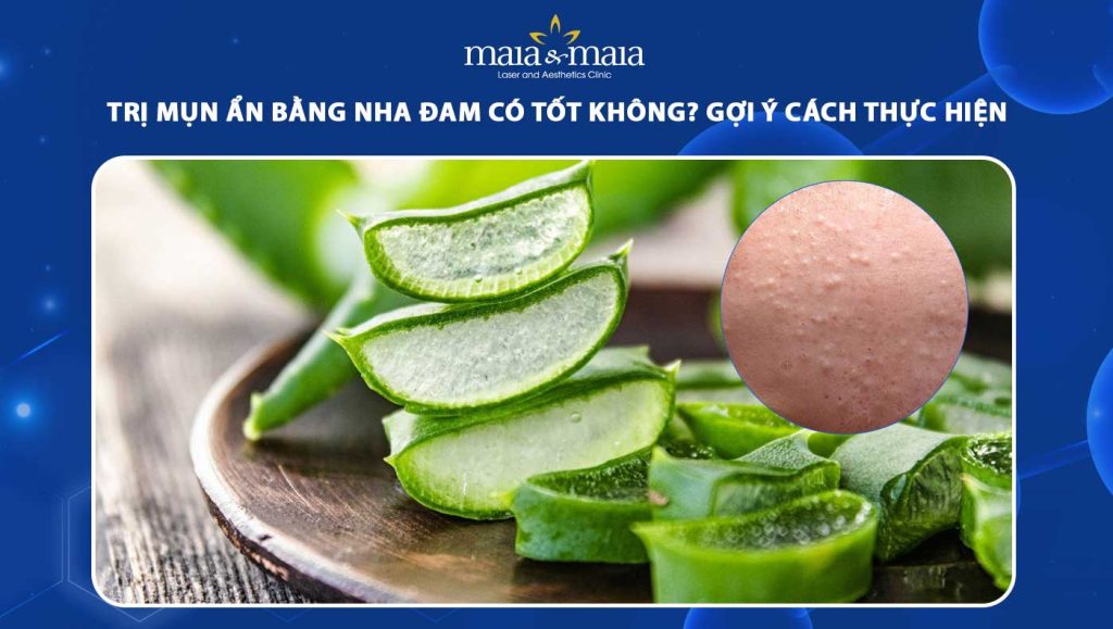 trị mụn ẩn bằng nha đam