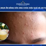 trị mụn ẩn bằng sữa ong chúa