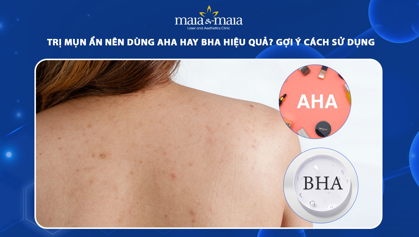 trị mụn ẩn nên dùng aha hay bha