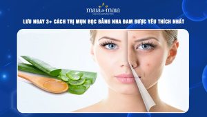 trị mụn bọc bằng nha đam