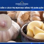 trị mụn bọc bằng tỏi
