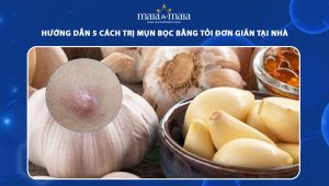 trị mụn bọc bằng tỏi