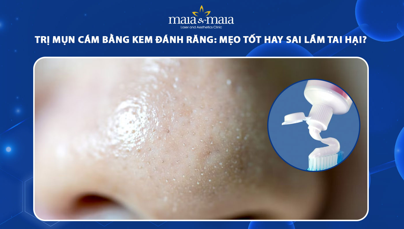 trị mụn cám bằng kem đánh răng