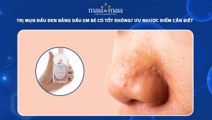 trị mụn đầu đen bằng dầu em bé