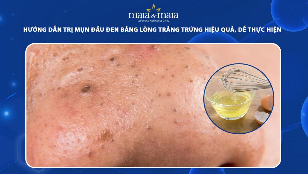 trị mụn đầu đen bằng lòng trắng trứng