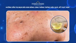 trị mụn đầu đen bằng lòng trắng trứng
