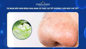 trị mụn đầu đen bằng nha đam