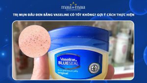 trị mụn đầu đen bằng vaseline
