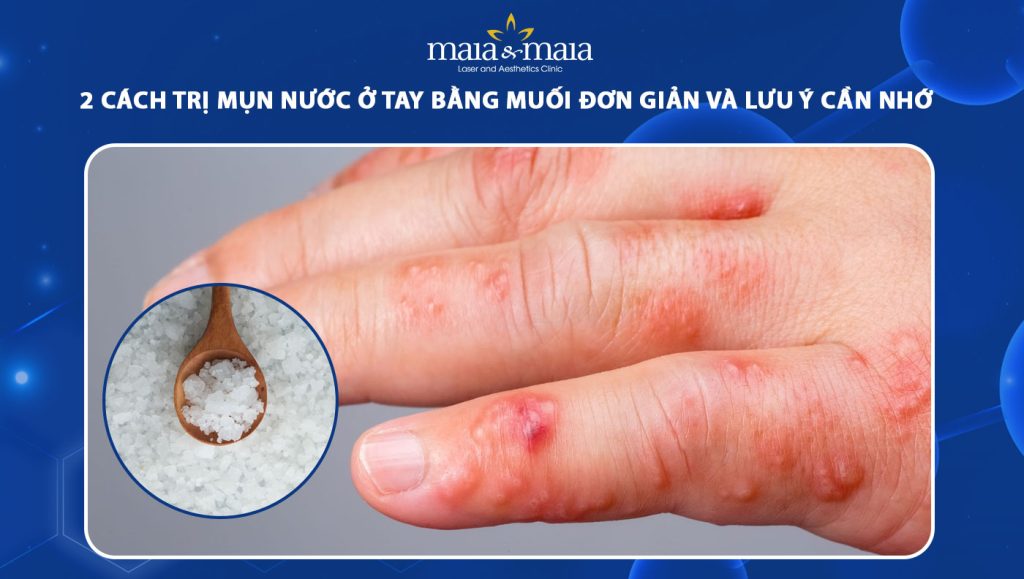 trị mụn nước ở tay bằng muối