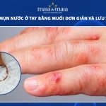 trị mụn nước ở tay bằng muối