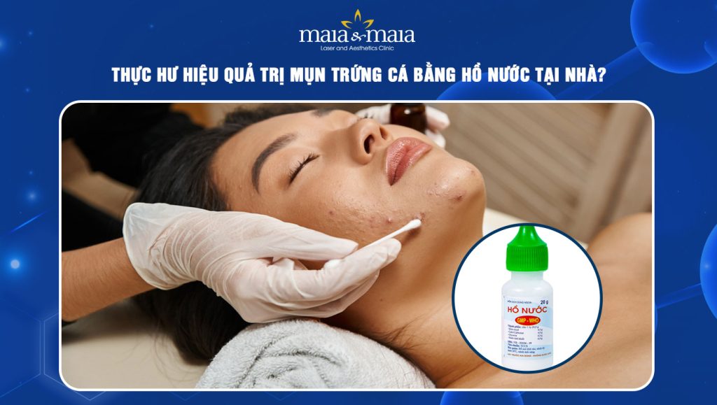 trị mụn trứng cá bằng hồ nước