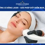 trị mụn trứng cá bằng laser