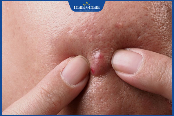 Phải làm sao khi mụn mủ bị vỡ? Cần lưu ý gì khi xử lý mụn? 2 tự ý nặn mụn mủ