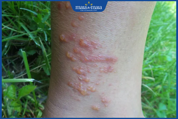 viêm da tiếp xúc