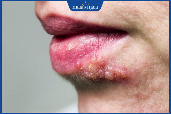 Mụn nước ở mặt có nguy hiểm không? Nguyên nhân và cách điều trị 2 zona