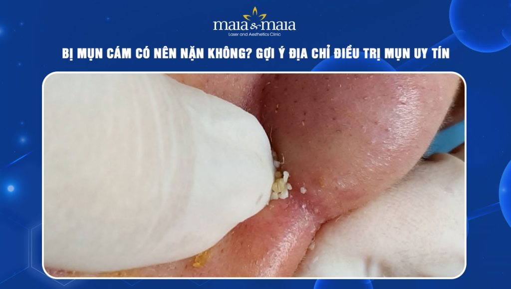 Bị mụn cám có nên nặn không? Gợi ý địa chỉ điều trị mụn uy tín 1 mụn cám có nên nặn không