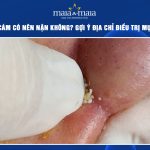 mụn cám có nên nặn không