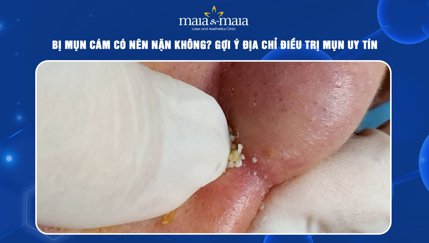 mụn cám có nên nặn không